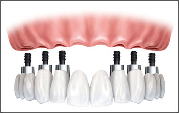 Базални зъбни импланти – какви се техните достойнства?